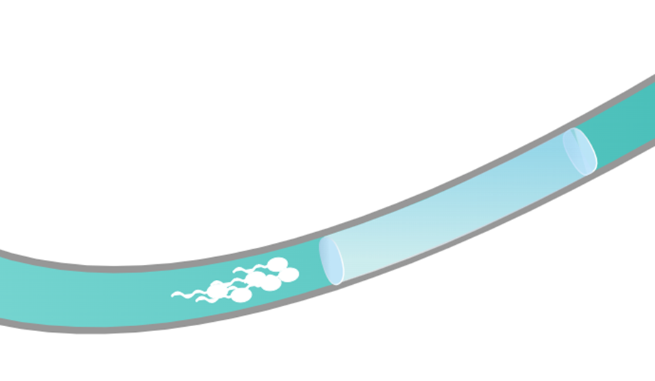 Crean implante anticonceptivo no hormonal para hombres que se inyecta en el escroto: ¿cómo funciona?