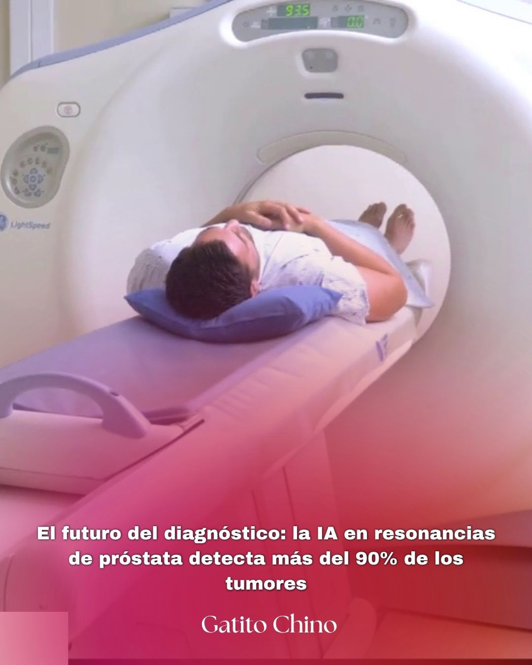Inteligencia Artificial en resonancia de próstata: el avance que salva vidas